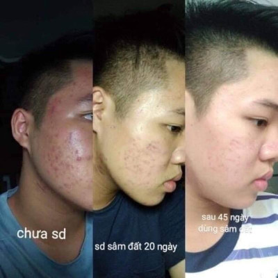 Tinh Chất Sâm Đất DR CELL 50ml tái tạo da, triệt tiêu mụn, mờ thâm nám, thu nhỏ chân lông