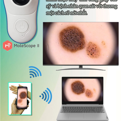 Dermoscopy - Thiết bị soi da tích hợp điện thoại và máy tính bảng MoleScope II