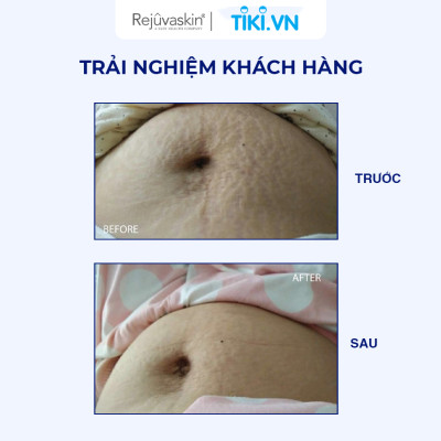 Kem phòng ngừa rạn da và giảm rạn da Rejuvaskin Stretch Mark Cream